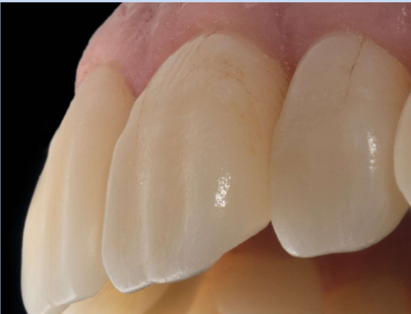 BSM Aconia TT-ML 3D Multilayer Zirconia - Image 3