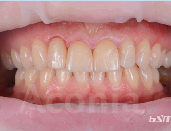 BSM Aconia TT-ML 3D Multilayer Zirconia - Image 2